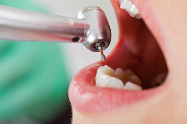 Best Emergency Tooth Extraction in Union City, OK